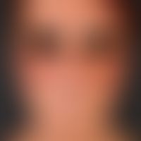 Mastozytosen (Übersicht): makulo-papulöse Mastozytose. Flächenhafter Befall der Wangenpartien.&nb...