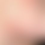 REM-Syndrom (Detail):&nbsp;im Decolleté- und Mammabereich lokalisierte, rote Papeln und kleinere ...