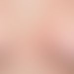 REM-Syndrom:&nbsp;im Decolleté- und Mammabereich lokalisierte, rote Papeln und kleinere Plaques.&...