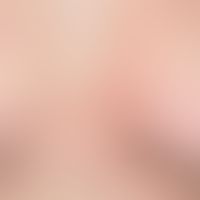 REM-Syndrom:&nbsp;im Decolleté- und Mammabereich lokalisierte, rote Papeln und kleinere Plaques.&...