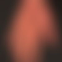 Atopische&nbsp;Dermatitis (Übersicht): &nbsp;ekzematöser Befall der Handflächen bei generalisiert...