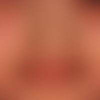 Chronische (atopische) Cheilitis bei generalisierter atopischer Dermatis (s. Lidbereich). Bekannt...