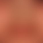 Cheilitis, atopische, bei generaliserter atopischer Dermatitis
