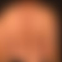 Typ I Neurofibromatose, peripherer Typ oder klassische kutane Form. Zahlreiche tiefliegende weich...
