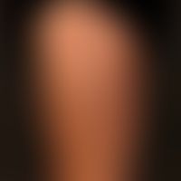 Neurofibrome: dermale und subkutane Neurofibrome bei bekanntem M. Recklinghausen.
