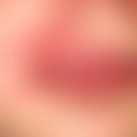 Melkersson-Rosenthal-Syndrom:&nbsp;persistierende, einseitige, gerötete Lippenschwellung bei eine...