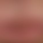 Differenzialdiagnose: Keratoakanthom

Diagnose: Lippenkarzinom; breitbasig aufsitzender, schmerzl...