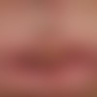 Differenzialdiagnose: Keratoakanthom

Diagnose: Lippenkarzinom; breitbasig aufsitzender, schmerzl...