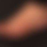 Psoriasis vulgaris chronisch-stationäre (Plaque-Typ): seit mehreren Jahren bereits bestehende,&nb...