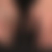Psoriasis: chronische (ungepflegte) Psoriasis palmaris&nbsp;mit flächenhaftem Befall.

&nbsp;
