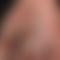 Psoriasis palmaris et plantaris (Plaquetyp): chronisch stationärer Typ. Ungepflegte Plaque-Psoria...