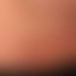 Dermatose IgA-lineare (Detail): frischer Schub einer vorbekannten,&nbsp;linearen IgA-Dermatose. H...