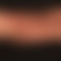 Dermatose IgA-lineare: frischer Schub einer vorbekannten,&nbsp;linearen IgA-Dermatose. Hier disse...