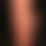 Lineare IgA-Dermatose: urtikarielle Plaques mit gestaffelten Bläschen-und Blasenformationen.

