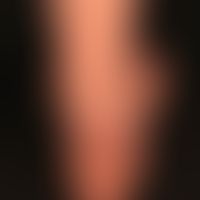 Lineare IgA-Dermatose: urtikarielle Plaques mit gestaffelten Bläschen-und Blasenformationen.
