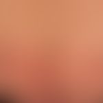Dermatose IgA-lineare: frischer Schub einer vorbekannten,&nbsp;&nbsp;linearen IgA-Dermatose. Hier...