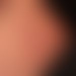 Dermatose IgA-lineare: frischer Schub einer vorbekannten,&nbsp;&nbsp;linearen IgA-Dermatose. Hier...