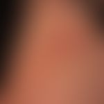 Dermatose IgA-lineare: frischer Schub einer vorbekannten,&nbsp;&nbsp;linearen IgA-Dermatose. Hier...