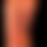 Mycosis fungoides vom Plaque-Typ:&nbsp;Teilaspekt einer ausgedehnten Mycosis fungoides vom Plaque...