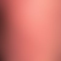 Mycosis fungoides vom Plaque-Typ:&nbsp;Teilaspekt einer ausgedehnten Mycosis fungoides vom Plaque...
