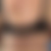 Pemphigoid bullöses:&nbsp; Bullöses Pemphigoid unter dem klinischen Bild einer Prurigo nodularis ...