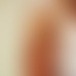 Pemphigoid bullöses:&nbsp; Bullöses Pemphigoid unter dem klinischen Bild einer Prurigo nodularis ...