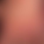Pemphigoiderkrankungen: Bullöses Pemphigoid, Handrücken.
