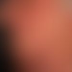 Lupus erythematodes chronicus discoides: &nbsp;chronisch aktive, rote, hyperästhetische Plaques m...