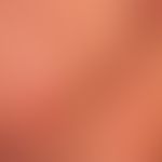 Lupus erythematodes chronicus discoides: &nbsp;chronisch aktive, rote, hyperästhetische Plaques m...