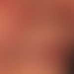 Lupus erythematodes chronicus discoides: &nbsp;chronisch aktive, rote, hyperästhetische Plaquesde...