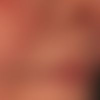 Lupus erythematodes chronicus discoides: &nbsp;chronisch aktive, rote, hyperästhetische Plaquesde...