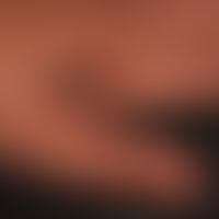 Naevus melanozytärer gewöhnlicher: angeborener großer melanozytärer Naevus&nbsp;. &nbsp;
