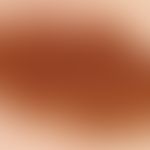 Naevus melanozytärer gewöhnlicher: angeborener großer melanozytärer Naevus&nbsp;. Auflichtmikrosk...