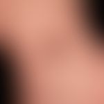 Naevus melanozytärer gewöhnlicher: angeborener großer melanozytärer Naevus&nbsp;. &nbsp;

