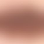 Naevus melanozytärer gewöhnlicher: angeborener großer melanozytärer Naevus&nbsp;. Lupenvergrößeru...