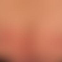 Differenzialdiagnose: Dermatitis herpetiformis

Diagnose: Lineare IgA-Dermatose. Disseminierte ur...