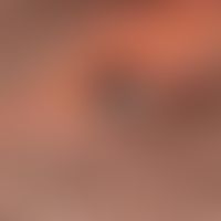 Hidradenom noduläres: Knotiger oberflächenglatter pigmentierter&nbsp; Knoten auf Naevus sebaceus....
