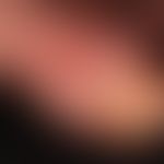 Differenzialdiagnose: Tinea manus

Diagnose:&nbsp;Schwimmbadgranulom; seit mehreren Monaten langs...