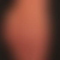 Chronischer Sonnenschaden: 64 Jahre alte Frau mit exzessiver Sonnenbelastung. Asugeprägte Faltenb...