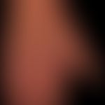Extrinsische Hautalterung (chronischer Sonnenschaden): 64 Jahre alte Frau mit exzessiver Sonnenbe...