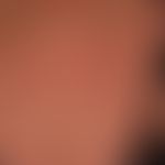 Extrinsische Hautalterung (chronischer Sonnenschaden): 64 Jahre alte Frau mit exzessiver Sonnenbe...