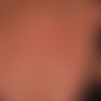 Extrinsische Hautalterung (chronischer Sonnenschaden): 64 Jahre alte Frau mit exzessiver Sonnenbe...