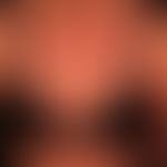 Extrinsische Hautalterung (chronischer Sonnenschaden): 64 Jahre alte Frau mit exzessiver Sonnenbe...