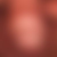 Lichen sclerosus: zirkulärer Befall von innerem und äußerem Präputialblatt. Glans penis frei. Gut...