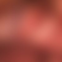 Lichen sclerosus: zirkulärer Befall von innerem und äußerem Präputialblatt. Glans penis frei.

&n...