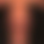 Pemphigoid bullöses: nahezu erythrodermisches Krankheitsbild mit flächigen, urtikariellen, erhebl...