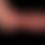 Pemphigoid, bullöses:&nbsp;Flächige Erytheme, flächige Erosionen und Ulzera, auf dem linken Fußrü...