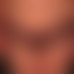 Pemphigoid bullöses: nahezu erythrodermisches Krankheitsbild mit flächigen, urtikariellen, erhebl...
