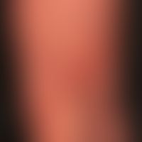 Pemphigoid bullöses:&nbsp;uncharakteristisches, vielgestaltiges klinisches Bild mit juckenden Ery...
