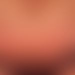 Pemphigoid bullöses: nahezu erythrodermisches Krankheitsbild mit flächigen, urtikariellen, erhebl...